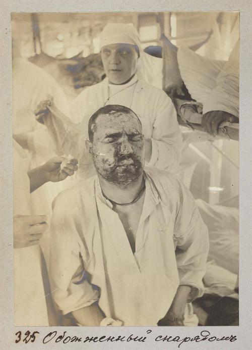 Burnt by explosion of the shell